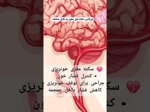 درمان سکته مغزی با دلایل مختلف