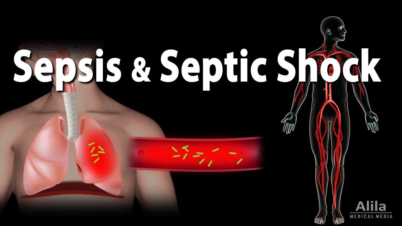 Sepsis and Septic Shock Animation