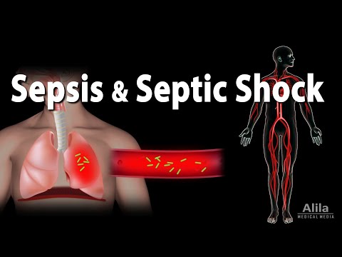 Video: Sepsis - Causes And Symptoms Of Sepsis