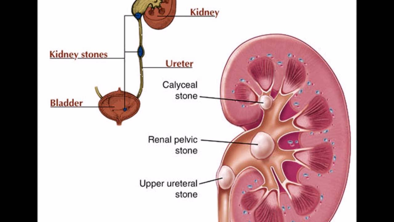 Лоханка латынь. Renal почки. Камень в лоханке почки на снимке.