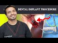 Dental implant surgery by dr inqalab fareed  multan  lahore