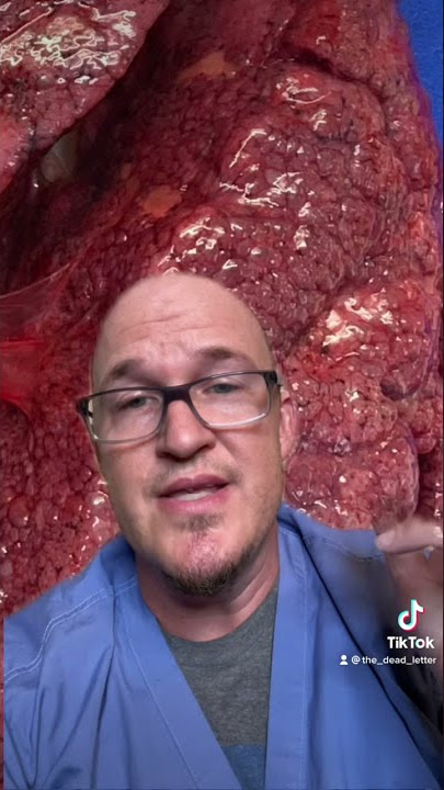 COVID Lungs at Autopsy (Pathology Macroscopic and Microscopic) #covid19 #medicine #autopsy