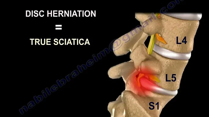 Low Back pain. Lumbar disc herniation, causes ,diagnosis ,symptoms and treatment