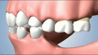 several teeth loss consequences