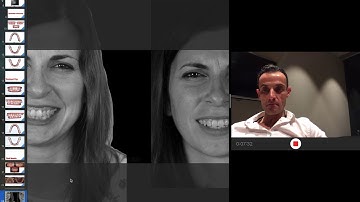 Aligners. Severe Class II, Deepbite and crowding. Invisalign.