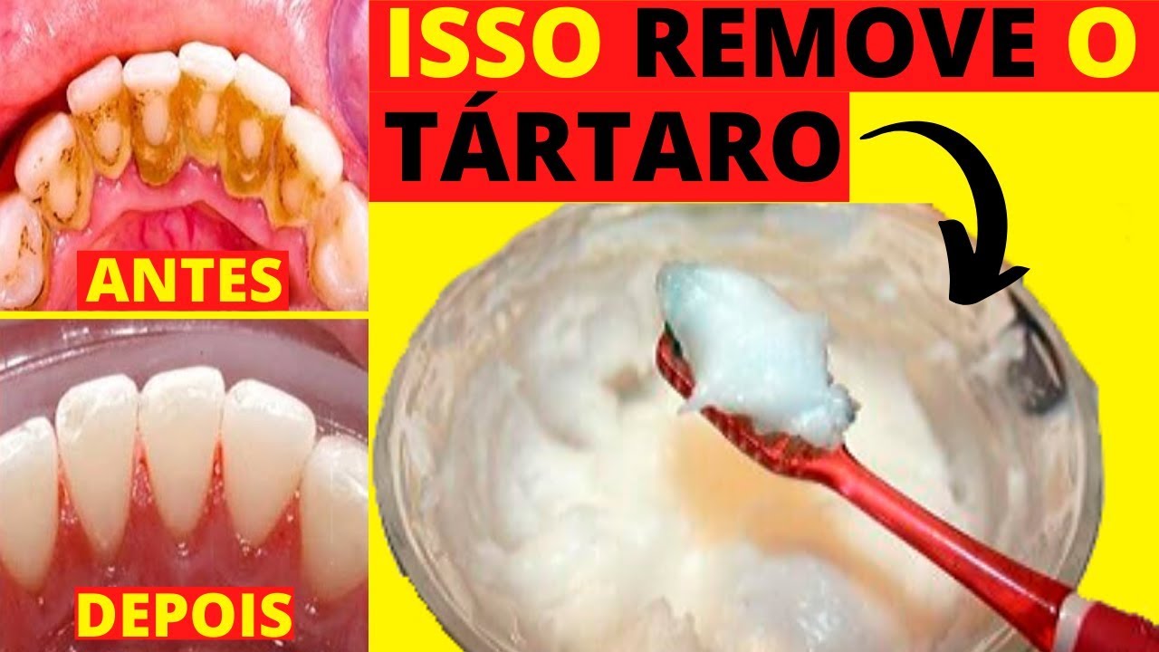 Como REMOVER o TÁRTARO dos DENTES em Casa e ter DENTES BRANCOS - YouTube
