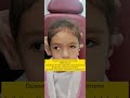Duane retraction syndrome- DRS type 3