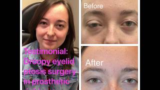 Ptosis Surgery in Prosthetic Eye -- Dr. Mehryar Taban-- CALL 310-299-8313 Prosthetic Eye Surgery Results
