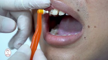 Dr. Trung hướng dẫn sử dụng bàn chải kẽ răng vệ sinh răng miệng