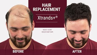 Hair Loss in Your 20s - There is a solution [ Hair replacement transformation ] screenshot 3