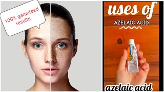 Get rid of freckles/melasma/hyperpigmentation/skin whitening/azelaic acid/pharmacy product