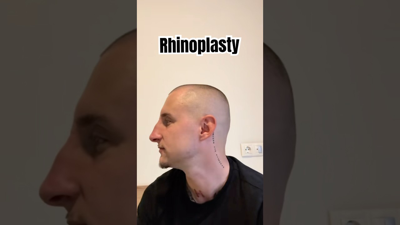 Rhinoplasty