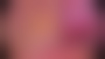 Asvide: Left upper apicoposterior segmentectomy S1, S2