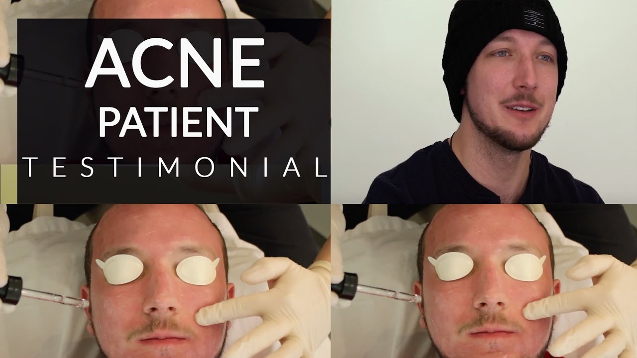 Acne Scar Treatment with Accutane & Laser | Accutane Before and After