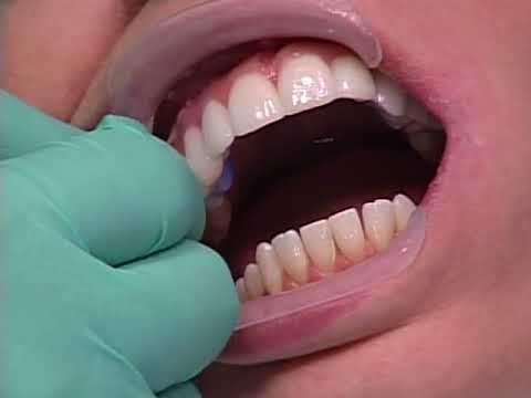 Heather: A Lumineers Veneers Clinical Case Study - DenMat Dental Education Heather: A Lumineers Veneers Clinical Case Study - DenMat Dental Education