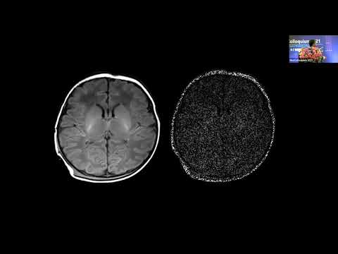 Video: Neuroimaging Ledtrådar Om Migrän Aura