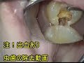 歯の神経がでる