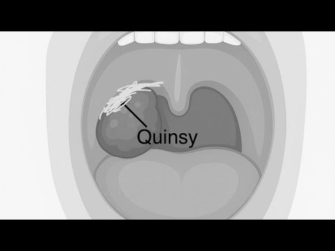 QUINSY