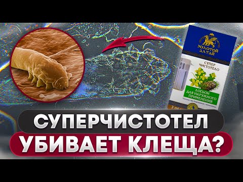 Угревая Железница Demodex | Как СУПЕРЧИСТОТЕЛ убивает клеща