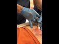 Huge Abscess