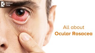 OCULAR ROSACEA- Red, Ichy, Watery Eyes. Causes, & Treatment-Dr. Sunita Rana Agarwal |Doctors' Circle