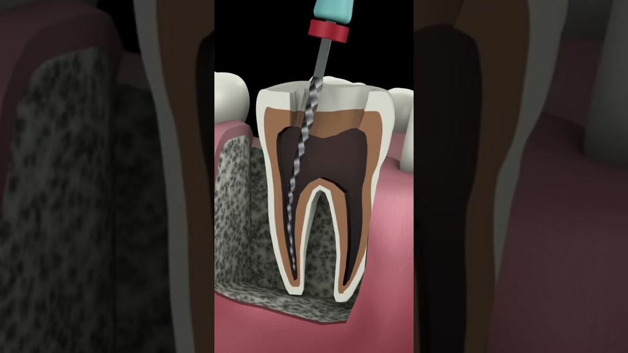 Root Canal Procedure Shorts
