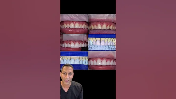 Porcelain Veneer Process with #drtejaspatel #cosmeticdentistry #porcelainveneers #veneer#shorts