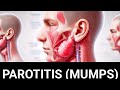 PAROTITIS (Mumps) कनफेडे ,कण्ठमाला, गलसुआ Explained: Causes, Symptoms, Diagnosis, and Treatment