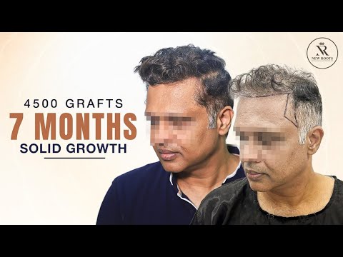 My Hair Actually Came Back… 😮 | Hair Transplant in Vashi (Navi Mumbai) | New Roots
