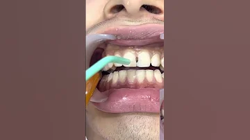 تجميل الأسنان الأمامية تنظيف تسوس الأسنان Etching For Composite Restoration 