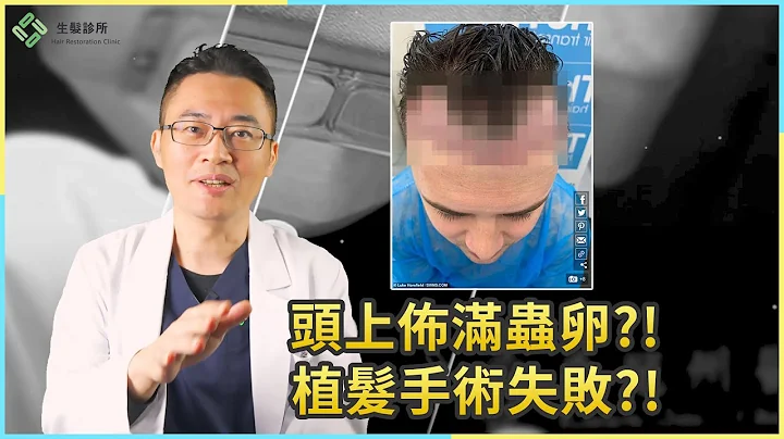英男到土耳其植髮失敗頭上布滿蟲卵？手術失敗？！｜生髮植髮專家朱冠州院長 - 天天要聞