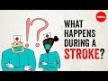 What happens during a stroke  vaibhav goswami