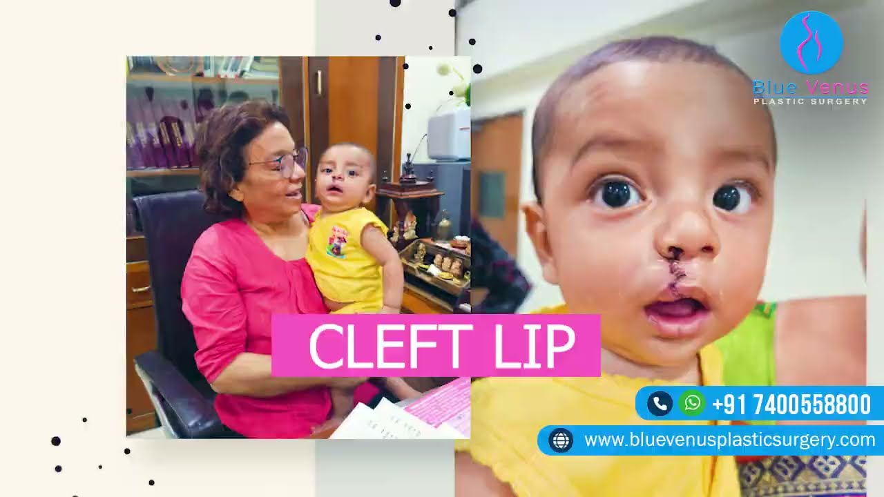 Free Cleft Lip Surgery Hospital In India - Best Cleft Plastic Surgeon - Raipur - Patient Feedback.
