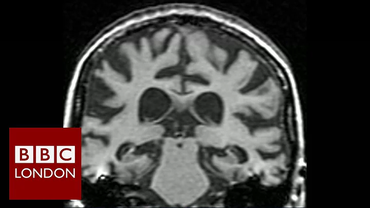 Dieting to delay dementia – BBC London