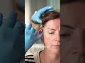 Migraine Treatment and Aftercare Leeds