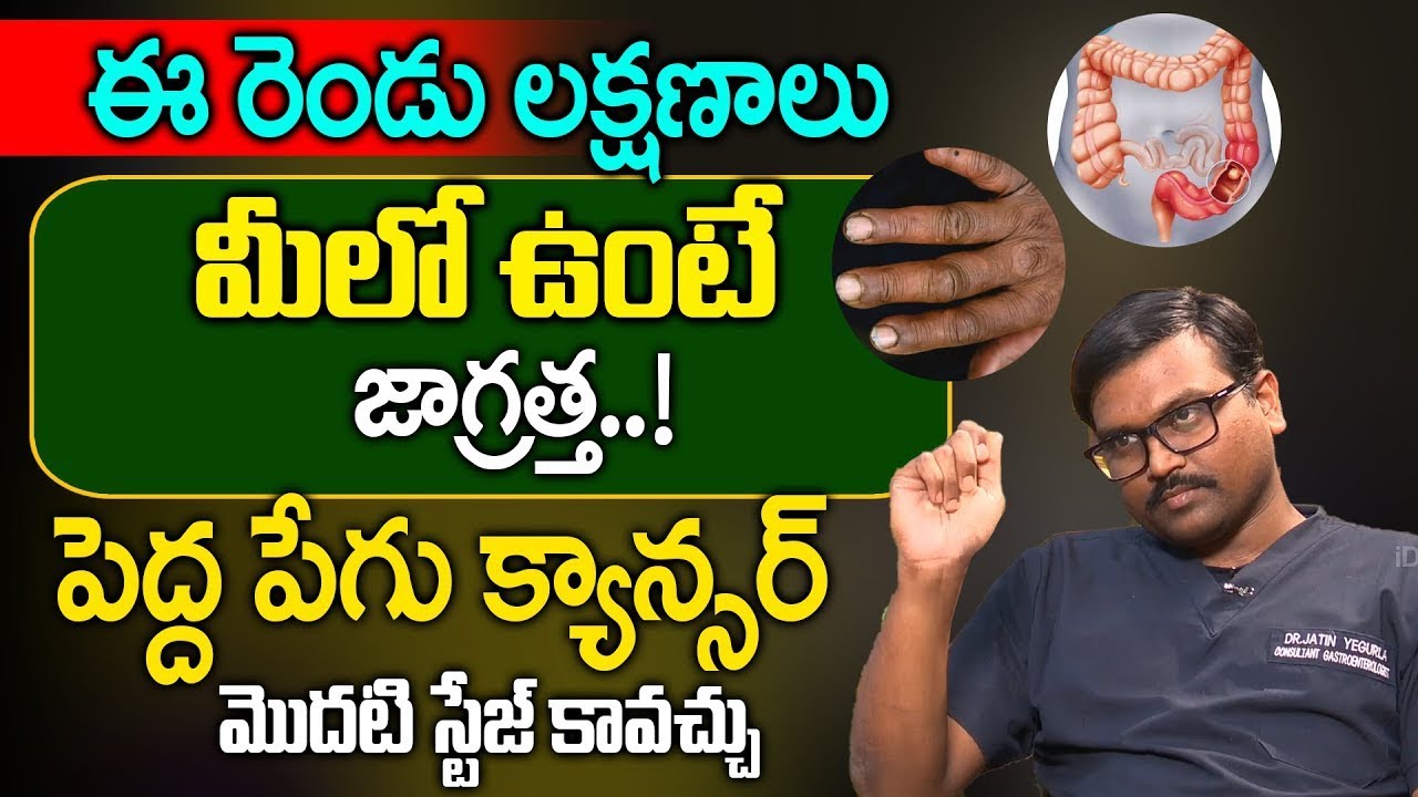 పెద్ద పేగు క్యాన్సర్ హెచ్చరిక | Colon Cancer Symptoms | Dr Y Jatin | iDream Super Doctor