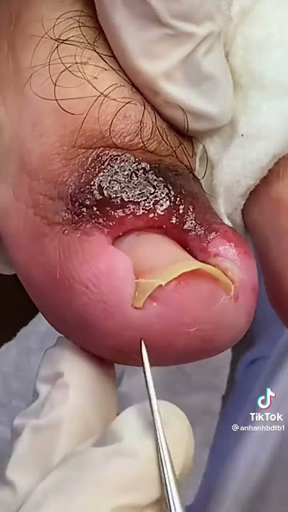 INFECTED Overgrown Toenail REMOVAL!!! ***Toe Meat 🥩***