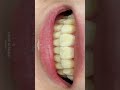 This smile changed with braces #braces #smilemakeover #koreadentist