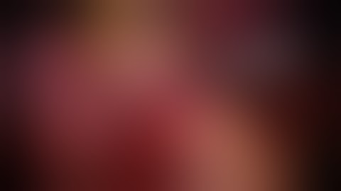 Laparoscopic cholecystectomy in a cirrhotic liver due to Hepatitis C by Dr Hitesh Chavda