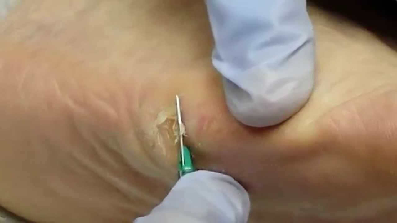 foot plantar callus