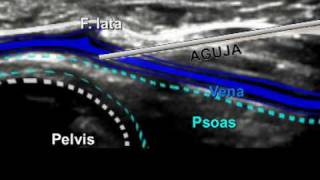 ACCESO VENOSO FEMORAL EN EL NEONATO Y LACTANTE MEDIANTE ECOGRAFÍA.