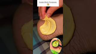 ✅ Get Rid of Crack Heels Treatment naturally Home Remedies #shorts #crackheelsolution