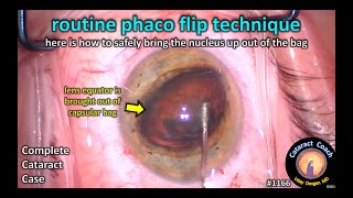 CataractCoach 1166: routine phaco flip technique screenshot 3
