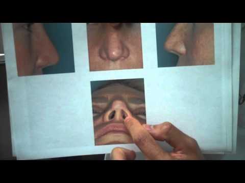 Video thumbnail: Plastic Surgery Miami: Revision Rhinoplasty Rib Graft - 1 Week Results