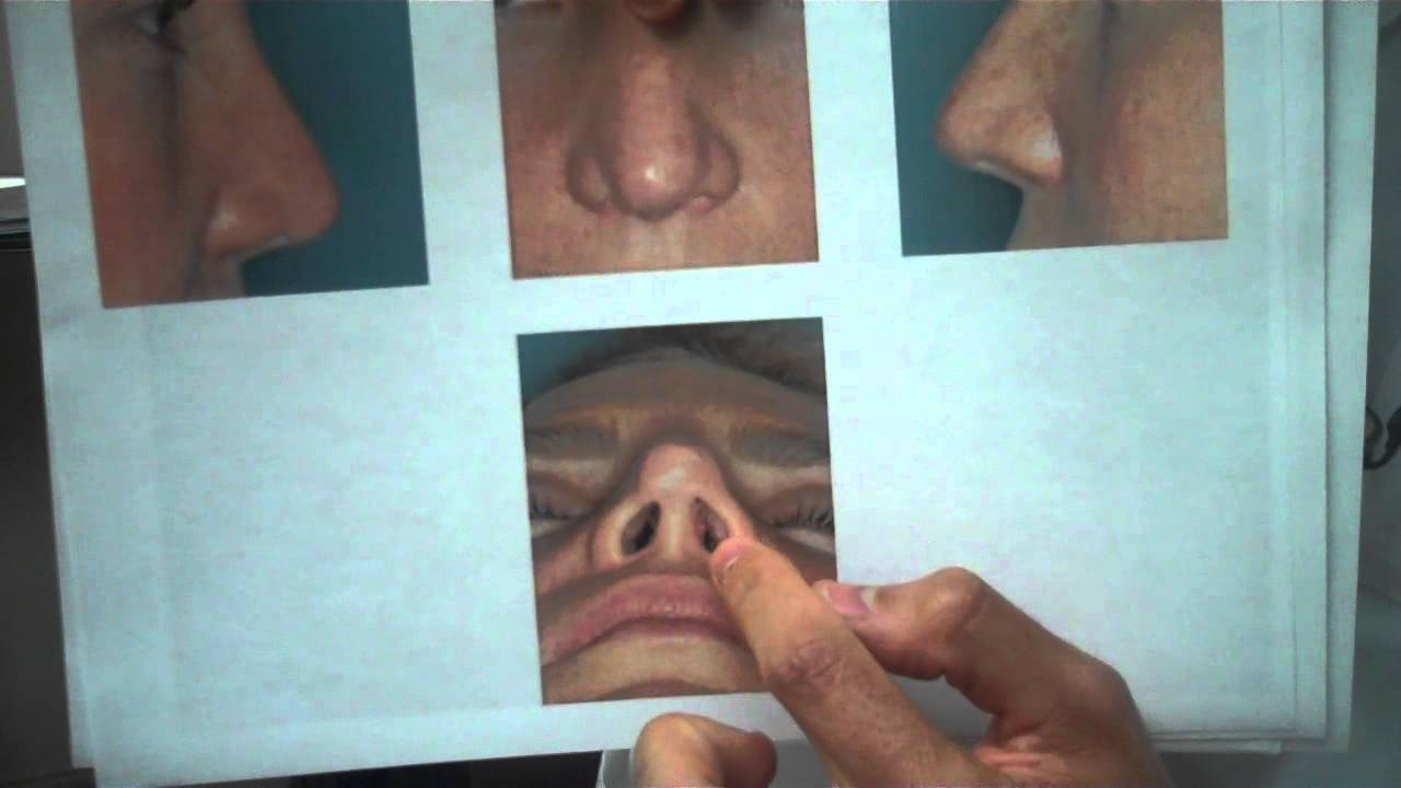 Plastic Surgery Miami: Revision Rhinoplasty Rib Graft - 1 Week Results