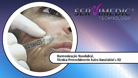 O que é o sulco Nasolabial?