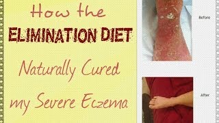 How the Elimination Diet Naturally Cured My Severe Eczema screenshot 3