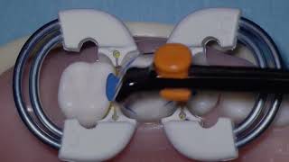 The Adjustable Push Pull Instrument för Bioclear matriser