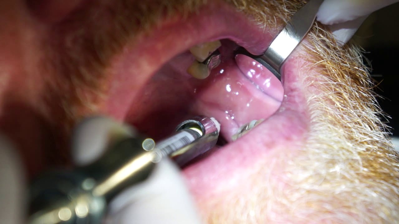 Ia Injection Rafe Inferior Alveolar (IA) Injection - YouTube