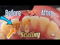 First Time Scaling |Tartar Removal| Male 23 y.o.| @dentist_ruli 23歳で初めて歯石を厚くスケーリング